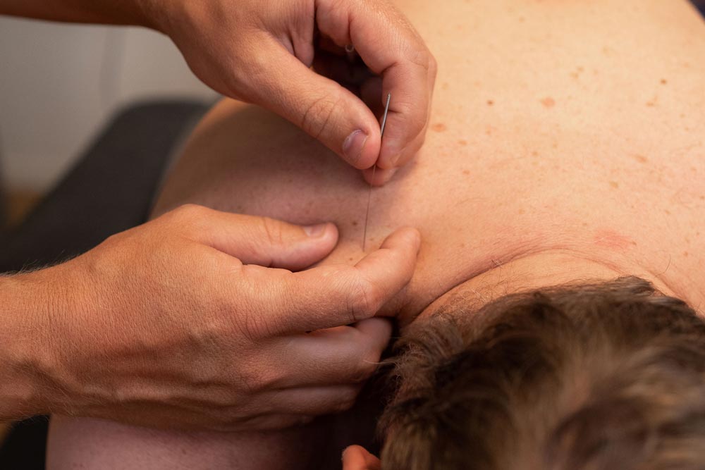 Naprapat som behandlar patient med dry needling