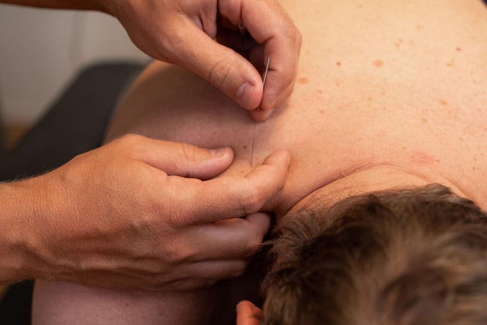 Naprapat som behandlar patient med dry needling